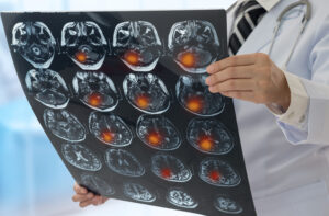 scan showing brain injuries