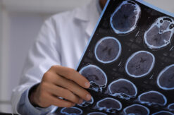 traumatic brain injury scans